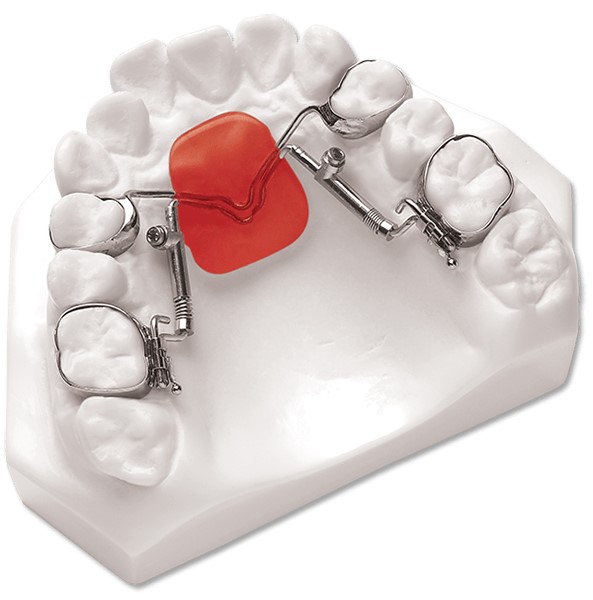 Distal Jet appliance showing bands around the back teeth and springs pushing from the acrylic button against the front palate. 