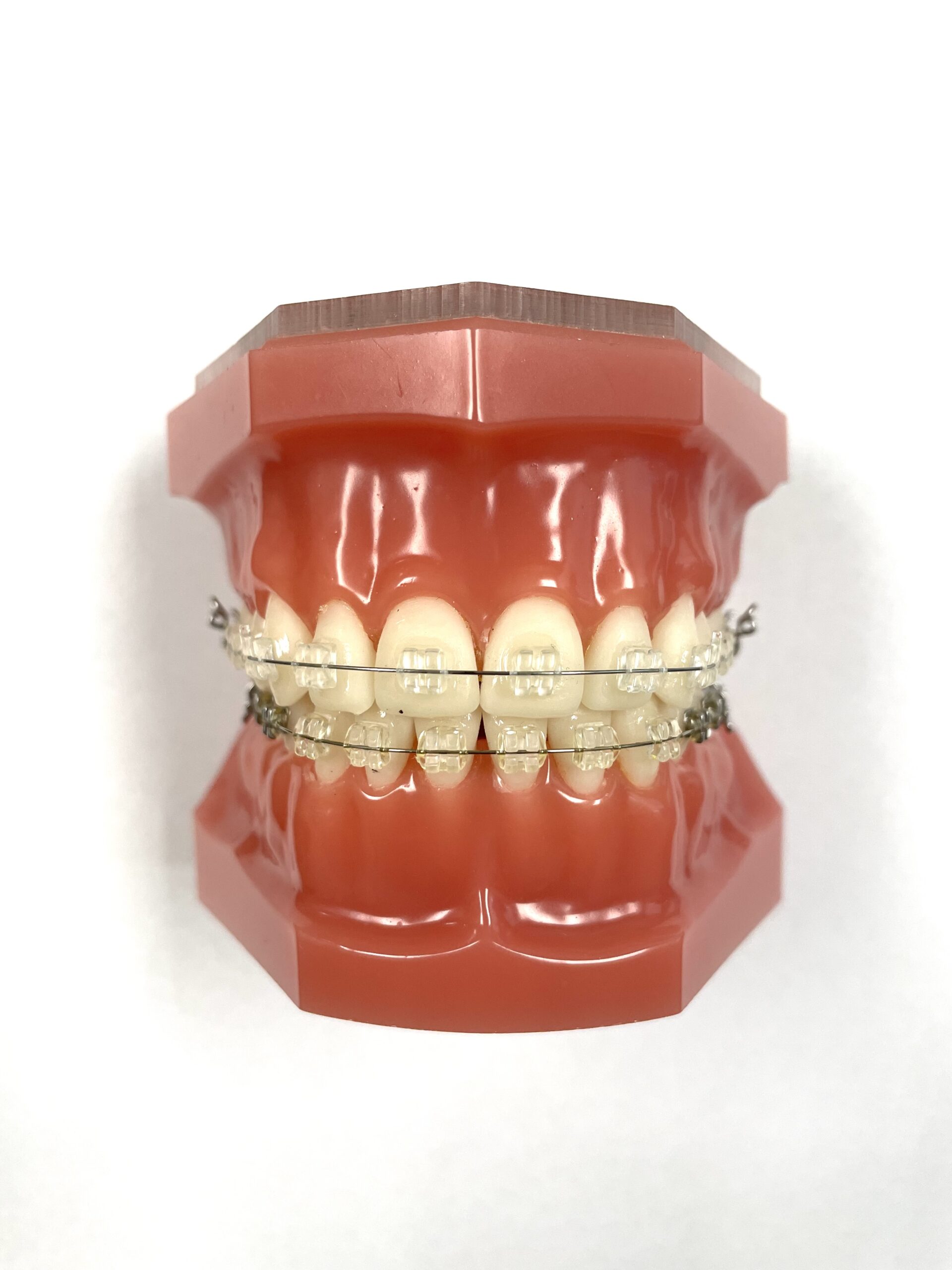 Ceramic brackets shown on a typodont which are a great treatment alternative for those that are not an Invisalign candidate and prefer a less visible treatment option.