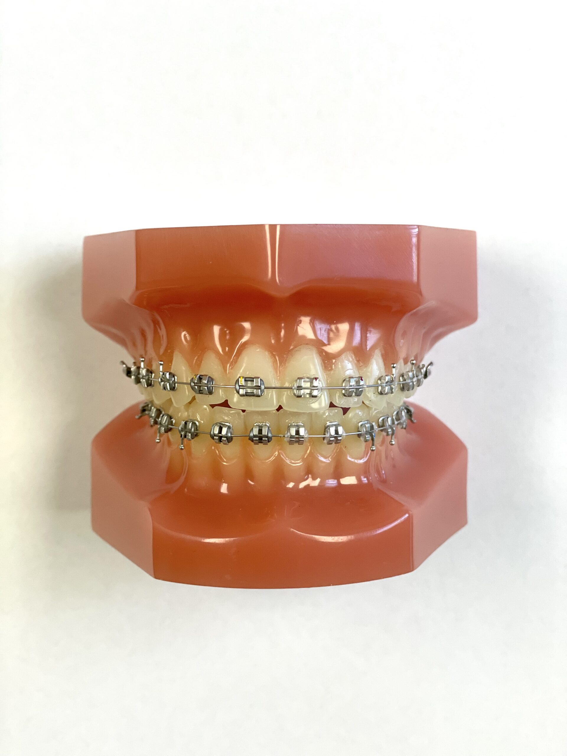 Traditional metal braces - Rhodium brackets
