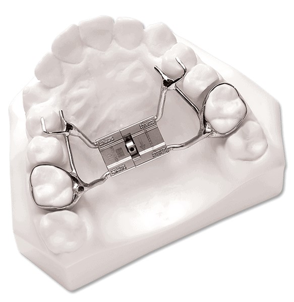 Rapid palatal expander shown on a typodont.