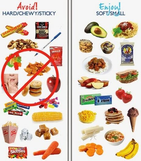 Comparison of foods safe for braces and foods that should be avoided.