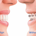 braces vs invisalign