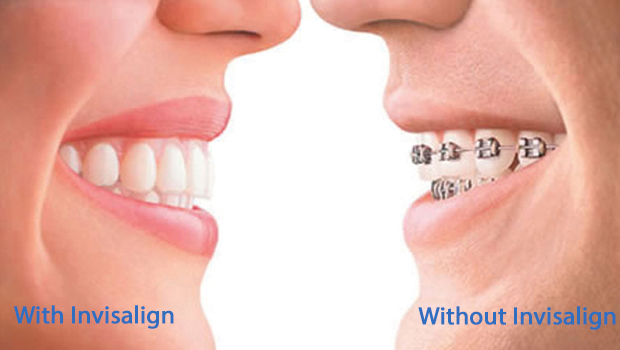 Braces vs. Invisalign: A Clear Comparison for a Straighter Smile